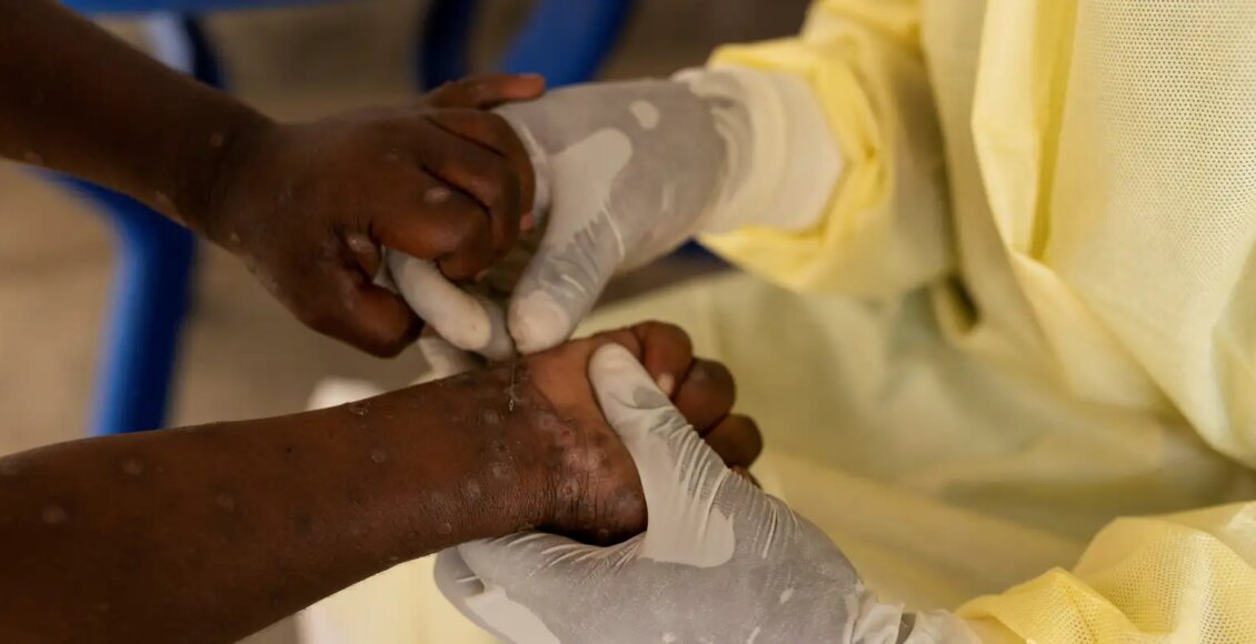 Brasil registra 88 casos de Mpox em 2026; saiba como evitar a doença
